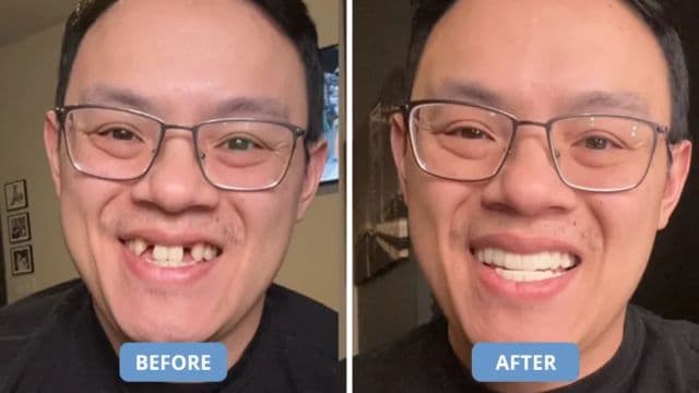 Shiny Smile Veneers